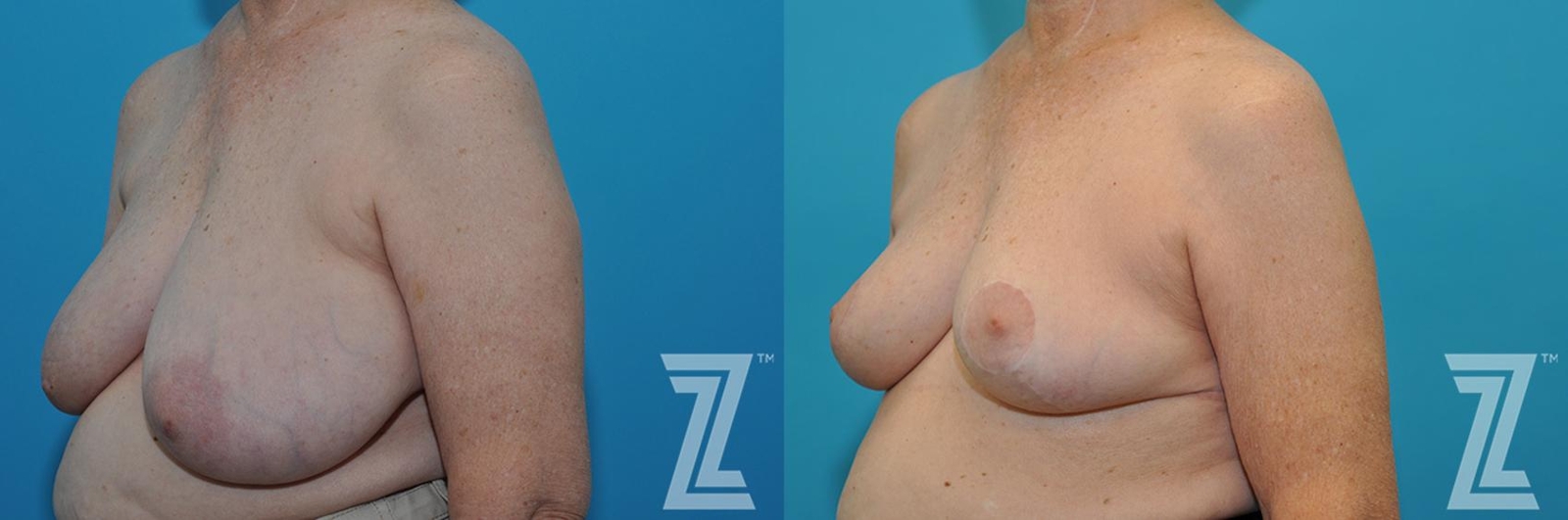 Austin Correction of Breast Asymmetry Before & After Gallery - Patient 132886776 - Image 2 - The Piazza Center
