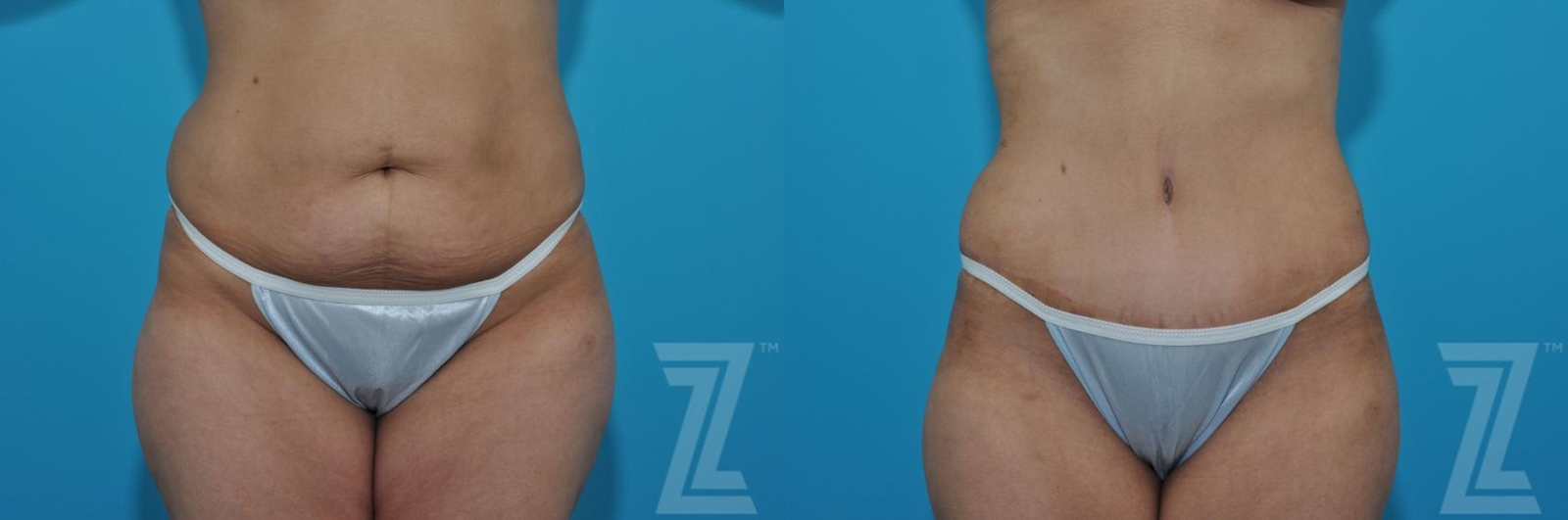Austin Tummy Tuck Before & After Gallery - Patient 132886901 - Image 1 - The Piazza Center