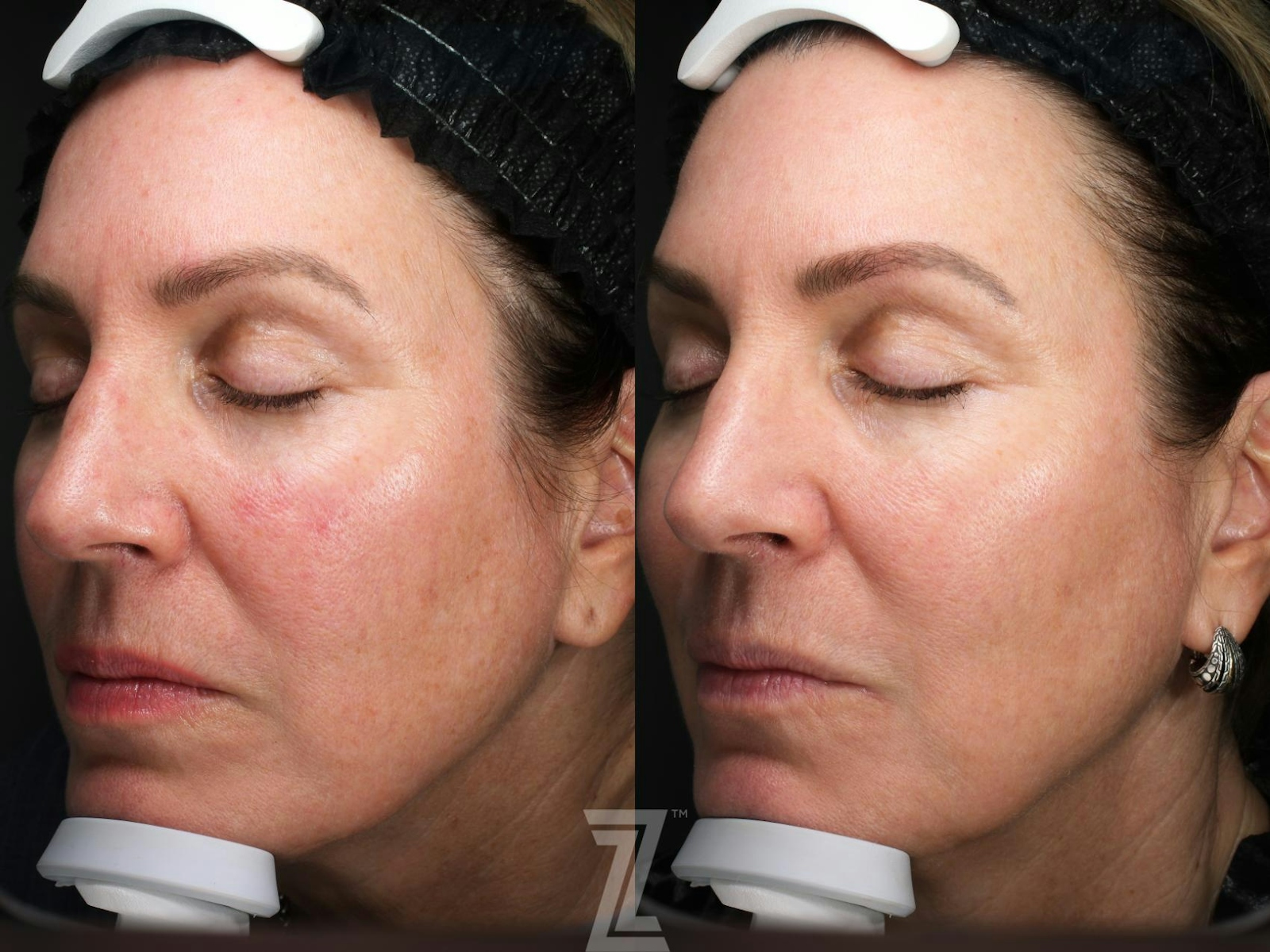 Austin Moxi Before & After Gallery - Patient 362380 - Image 1 - The Piazza Center