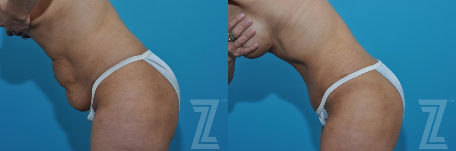 Austin Tummy Tuck Before & After Gallery - Patient 132886901 - Image 3 - The Piazza Center