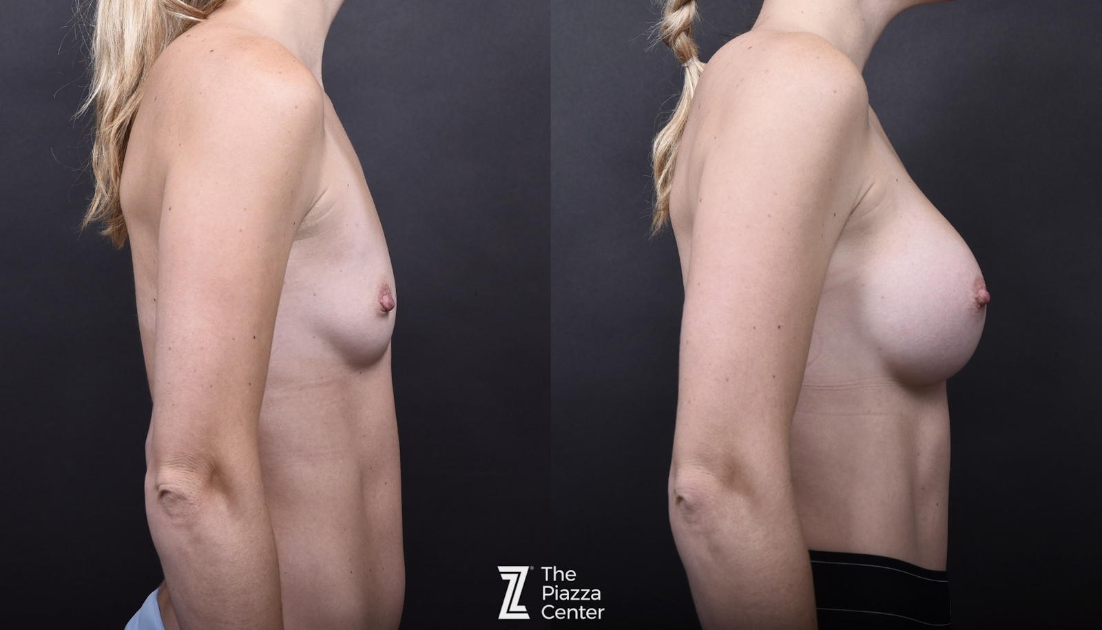Austin Breast Augmentation Side Comparison - The Piazza Center