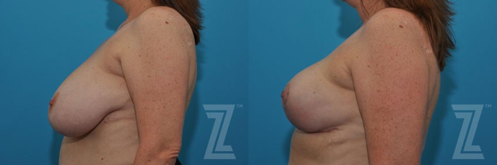 Austin Breast Reduction Before & After Gallery - Patient 132886747 - Image 3 - The Piazza Center