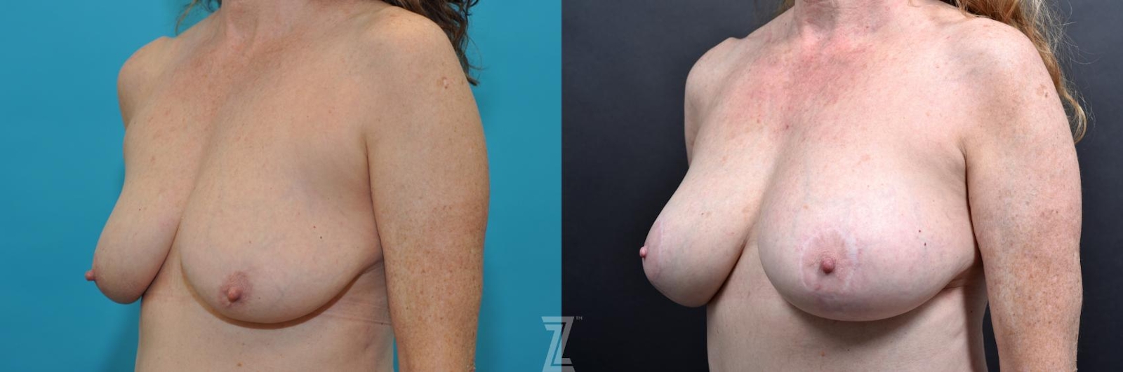 Austin Oblique breast view 7 year post op mommy makeover - The Piazza Center, Austin Tx - The Piazza Center