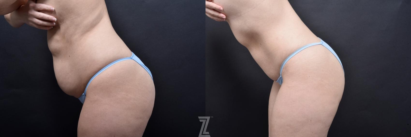 Austin Skin Pinch Before & After Gallery - Patient 132886936 - Image 3 - The Piazza Center