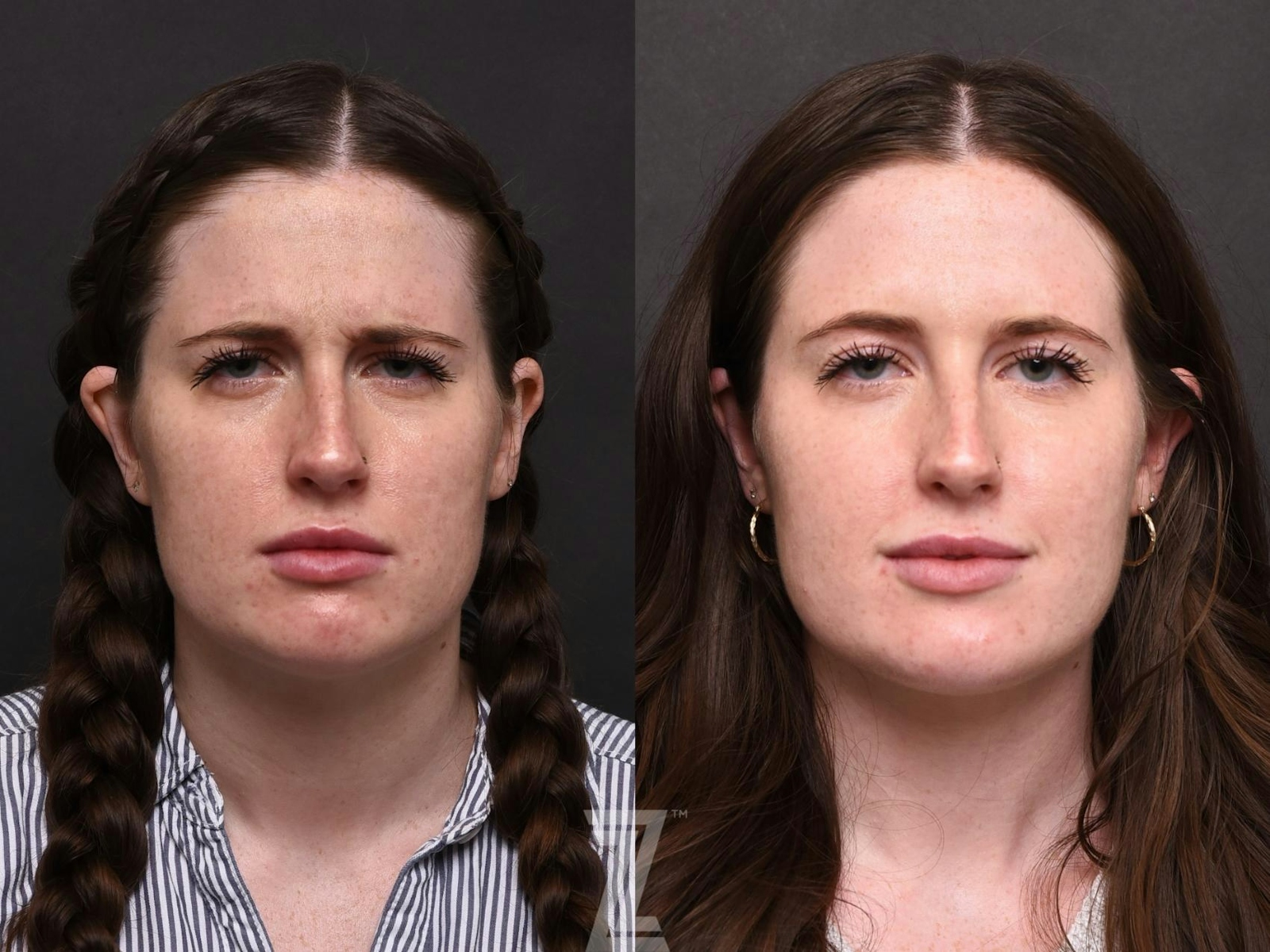 Austin Wrinkle Relaxers Before & After Gallery - Patient 132906322 - Image 2 - The Piazza Center
