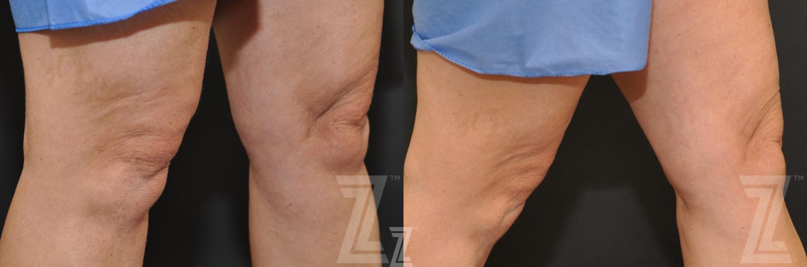 Austin CoolSculpting® Before & After Gallery - Patient 132905392 - Image 2 - The Piazza Center