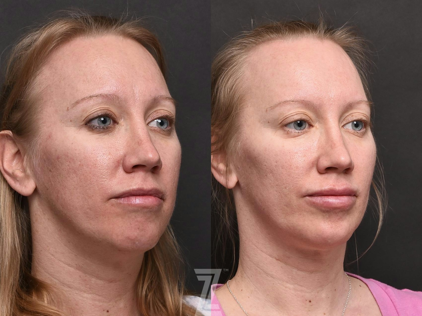 Austin Injectable Fillers Before & After Gallery - Patient 132963112 - Image 2 - The Piazza Center