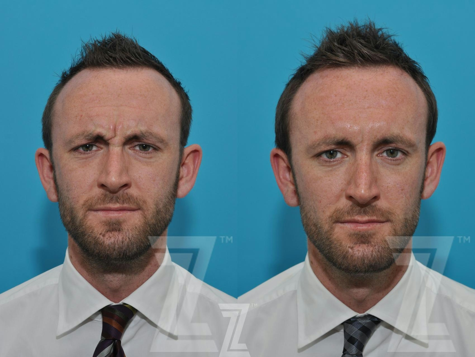 Austin Male Injectables Before & After Gallery - Patient 106343 - Image 2 - The Piazza Center