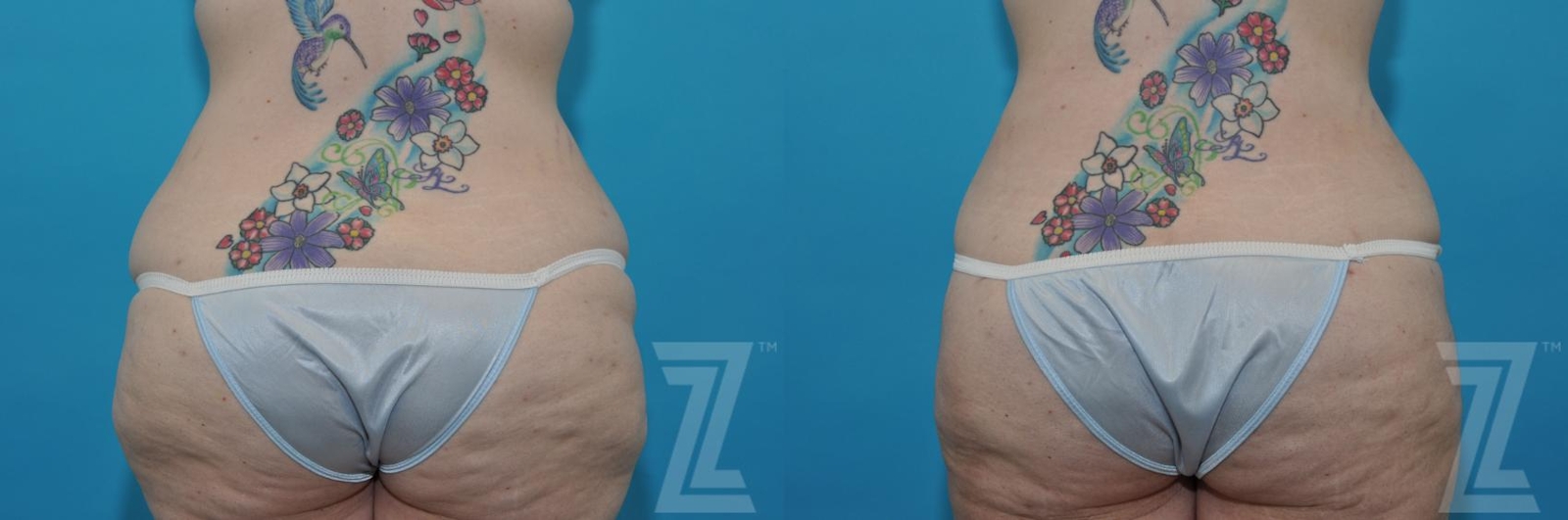 Austin Tummy Tuck Before & After Gallery - Patient 132886824 - Image 4 - The Piazza Center