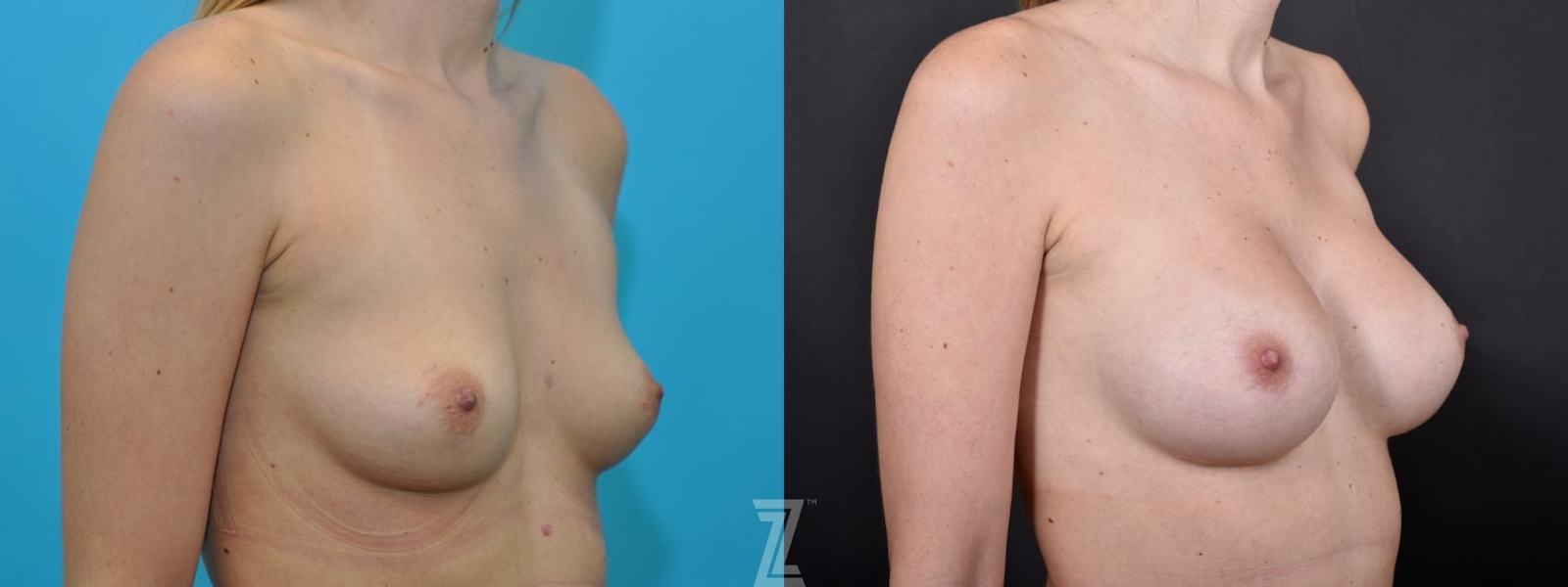 Austin Oblique before and after image of 25 year old woman with Silicone Implants with Highly Cohesive Gel (Gummy Bear Implants) - The Piazza Center