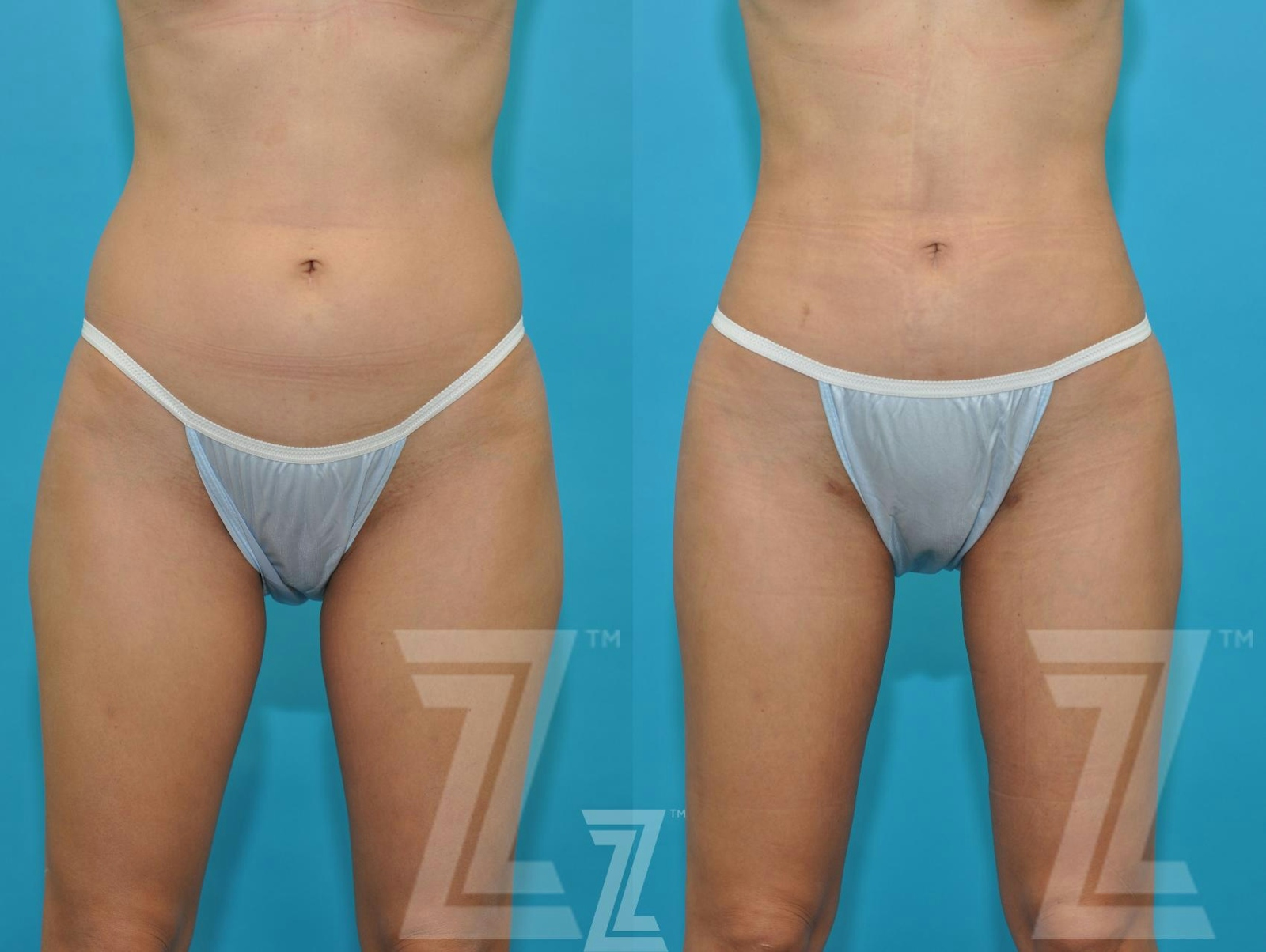 Austin Liposuction Before & After Gallery - Patient 132893822 - Image 1 - The Piazza Center