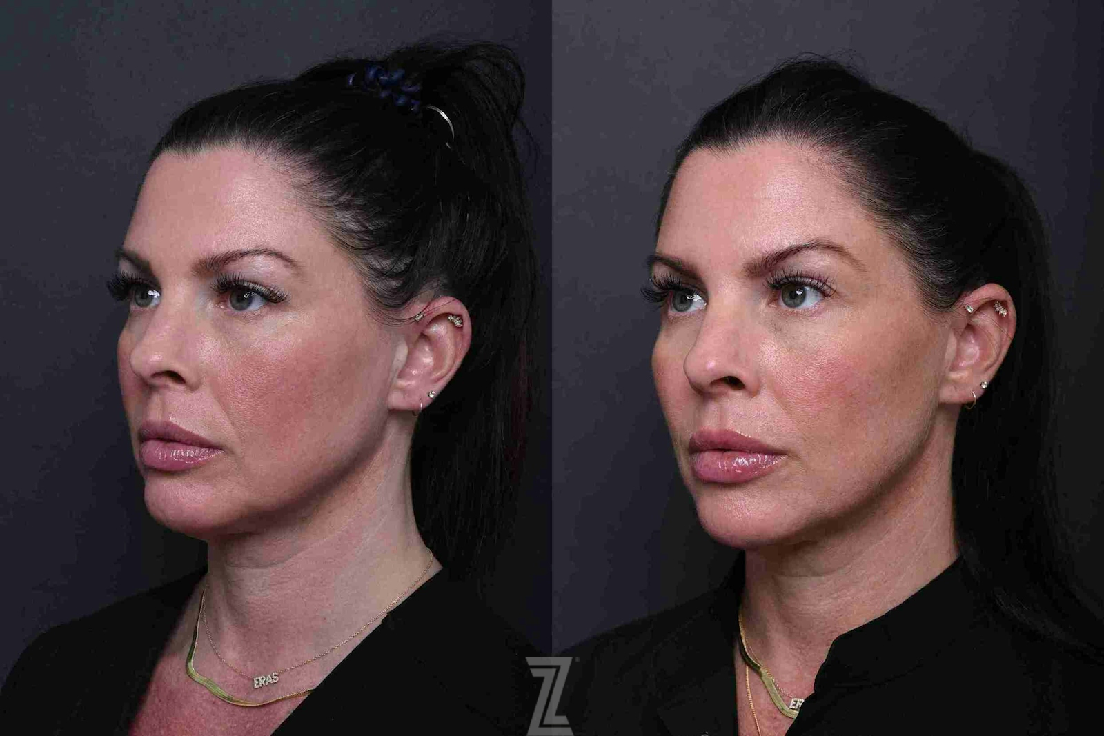 Austin Wrinkle Relaxers Side Comparison - The Piazza Center