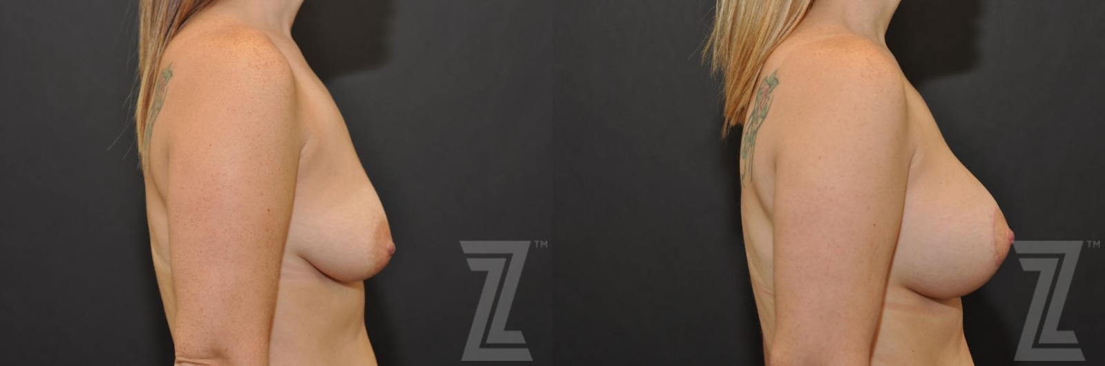 Austin Breast Augmentation With a Breast Lift Before & After Gallery - Patient 132791094 - Image 5 - The Piazza Center