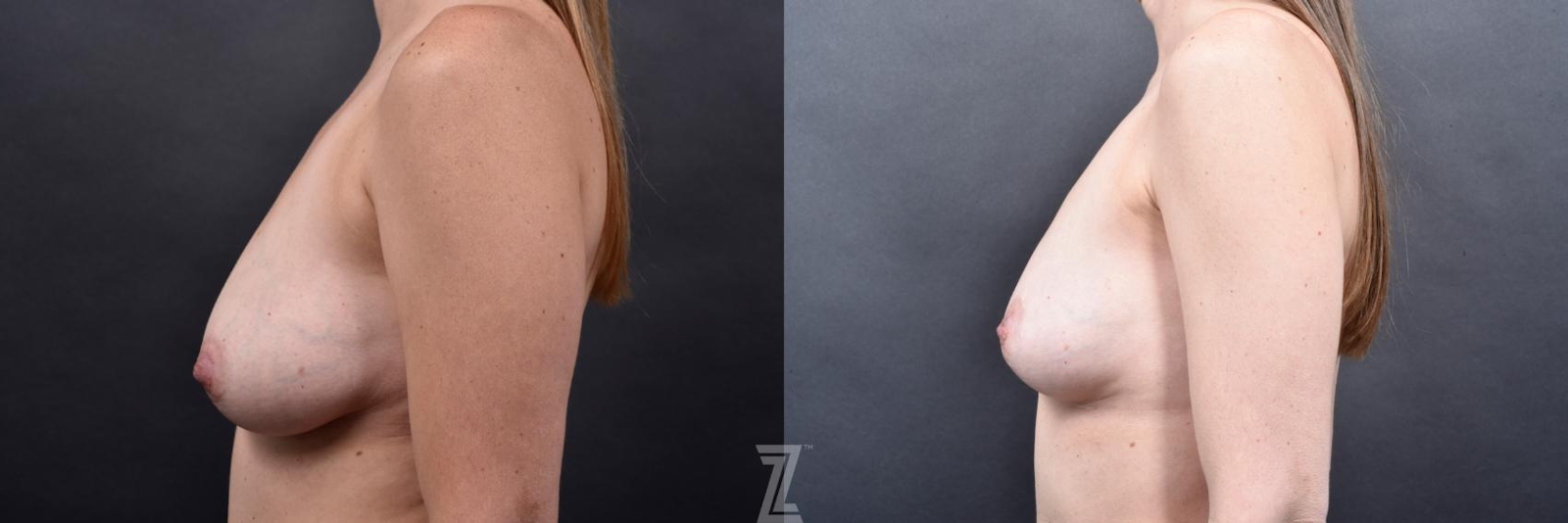 Austin Breast Reduction Before & After Gallery - Patient 606521 - Image 3 - The Piazza Center