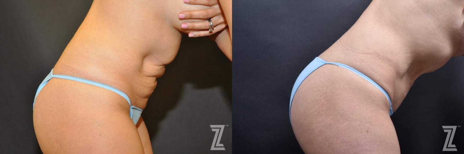 Austin Skin Pinch Before & After Gallery - Patient 132886938 - Image 5 - The Piazza Center