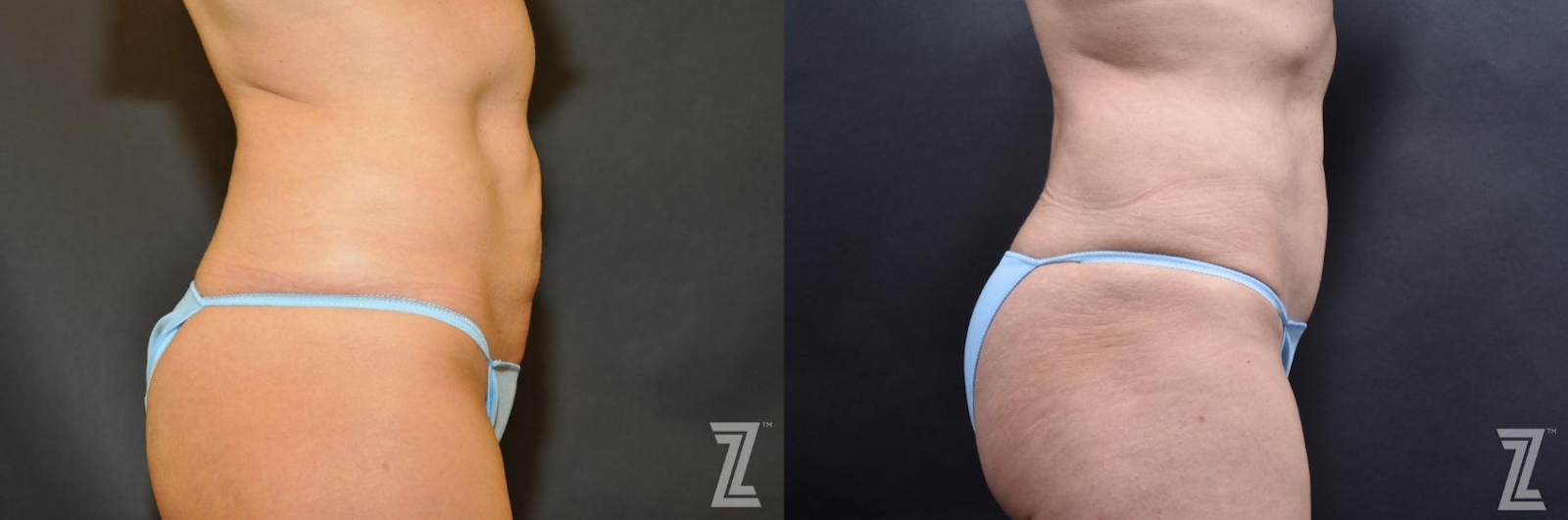 Austin Skin Pinch Before & After Gallery - Patient 132886938 - Image 4 - The Piazza Center