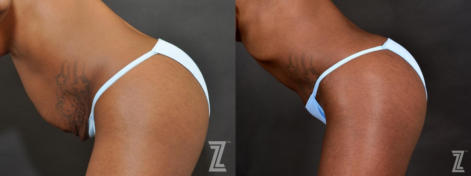 Austin Tummy Tuck Before & After Gallery - Patient 132886804 - Image 4 - The Piazza Center