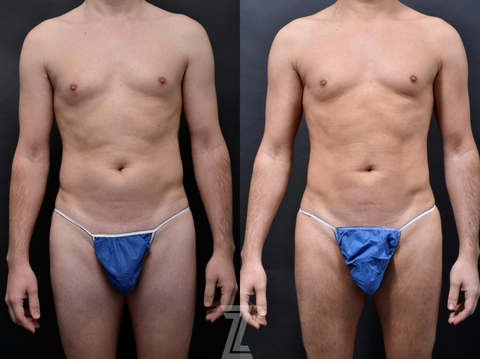 Austin Male Body Contouring Before & After Gallery - Patient 273342 - Image 1 - The Piazza Center