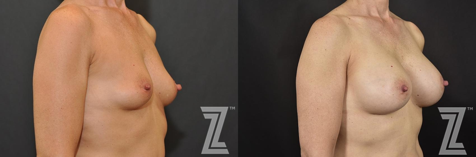 Austin 53 Year Old 3 year Post-OP Breast Augmentation Before & After in Austin, TX - The Piazza Center -oblique View - The Piazza Center