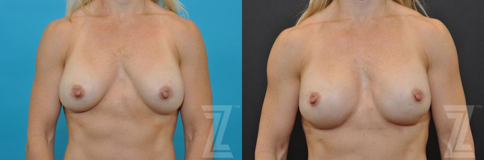 Austin Breast Augmentation Revision Before & After Gallery - Patient 132886580 - Image 1 - The Piazza Center