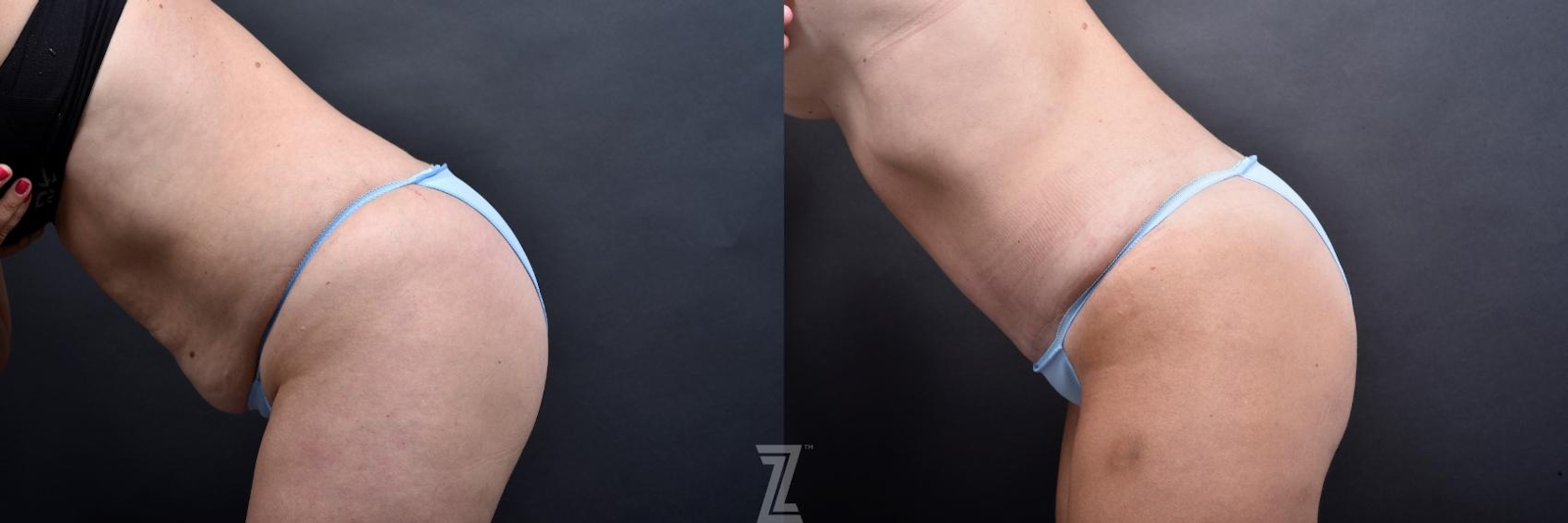 Austin Tummy Tuck Before & After Gallery - Patient 132886865 - Image 3 - The Piazza Center