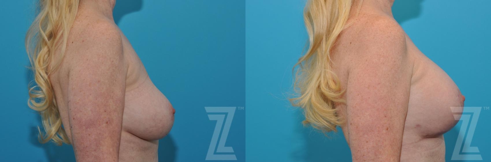 Austin Breast Augmentation Revision Before & After Gallery - Patient 132794909 - Image 5 - The Piazza Center