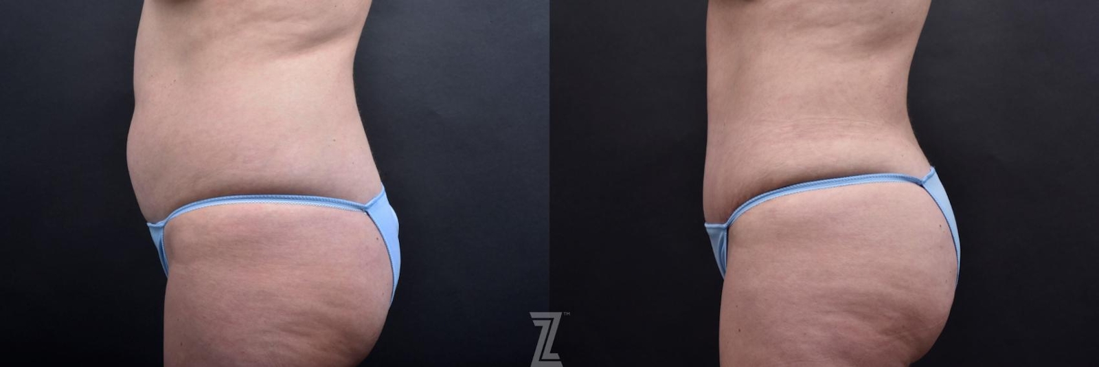 Austin Tummy Tuck Before & After Gallery - Patient 132886885 - Image 2 - The Piazza Center