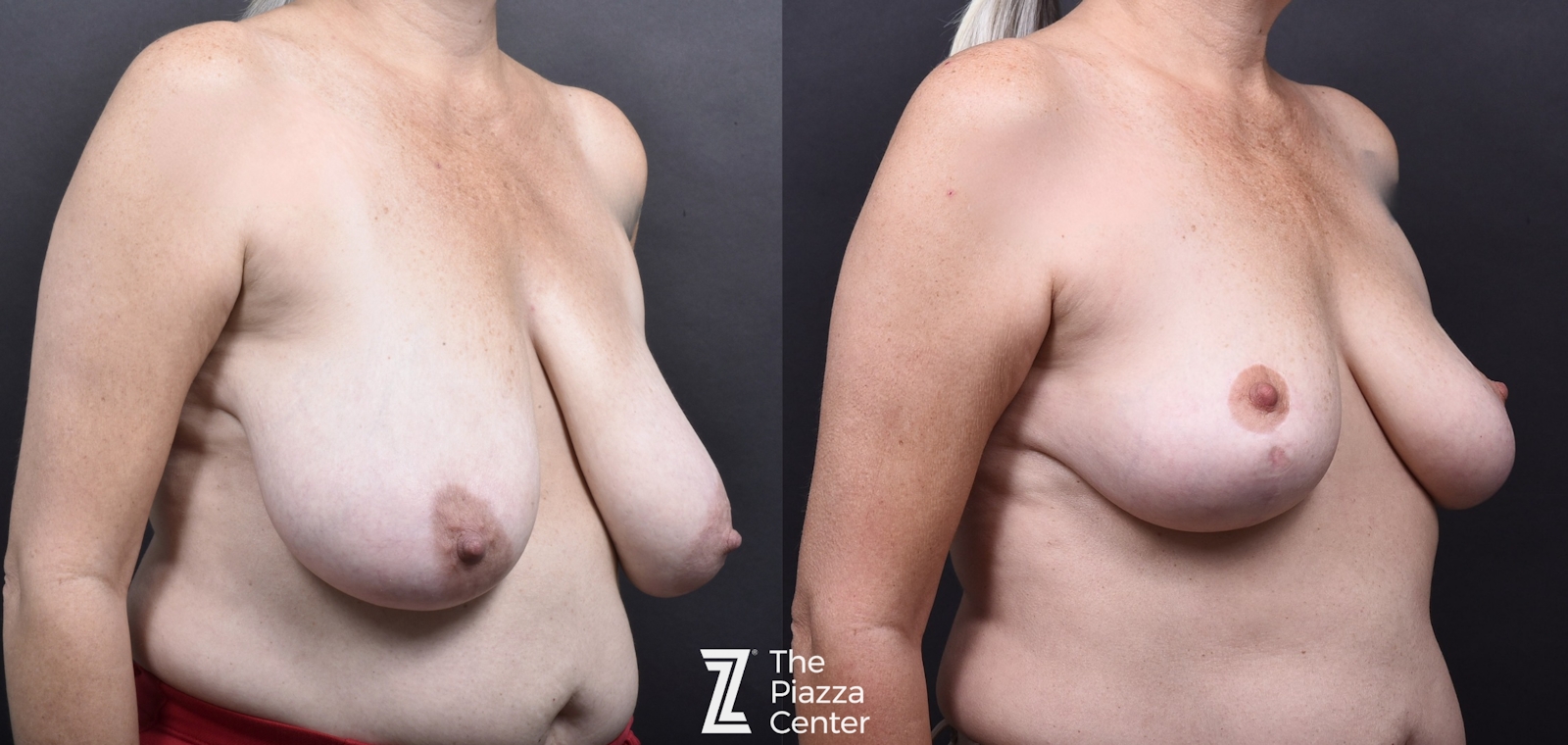 Austin Breast Reduction Before & After Gallery - Patient 132886597 - Image 2 - The Piazza Center