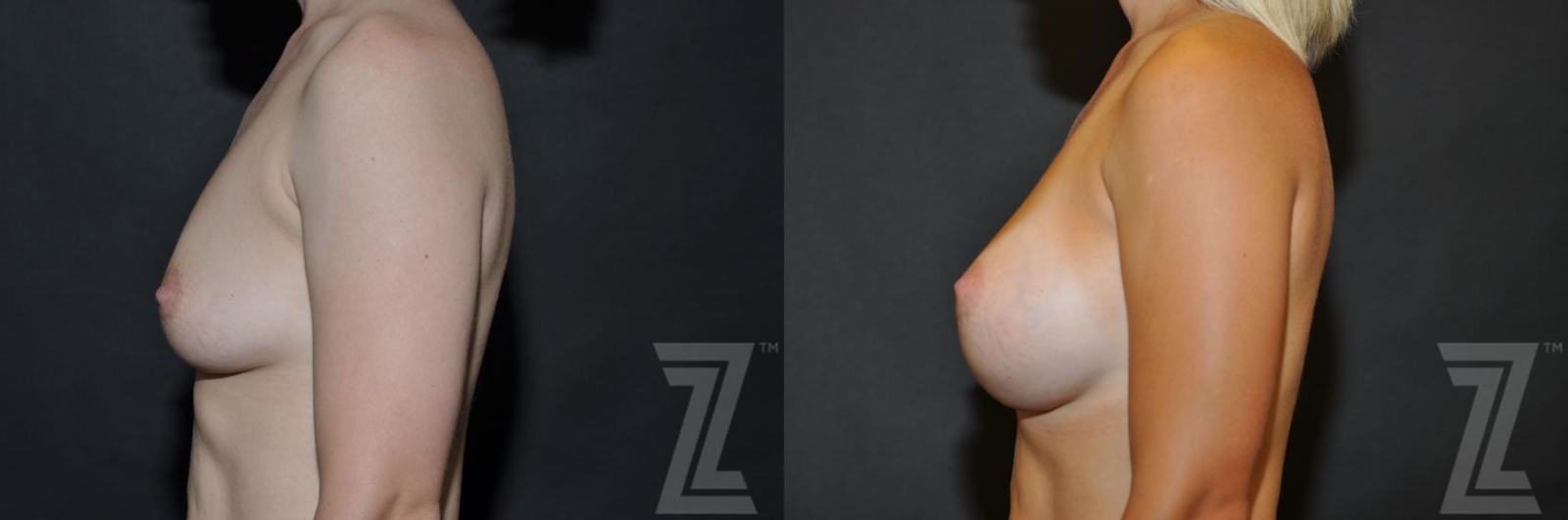 Austin Lateral View 6 Months After Breast Augmentation in Austin, TX Before & After by Dr. Rocco Piazza - The Piazza Center