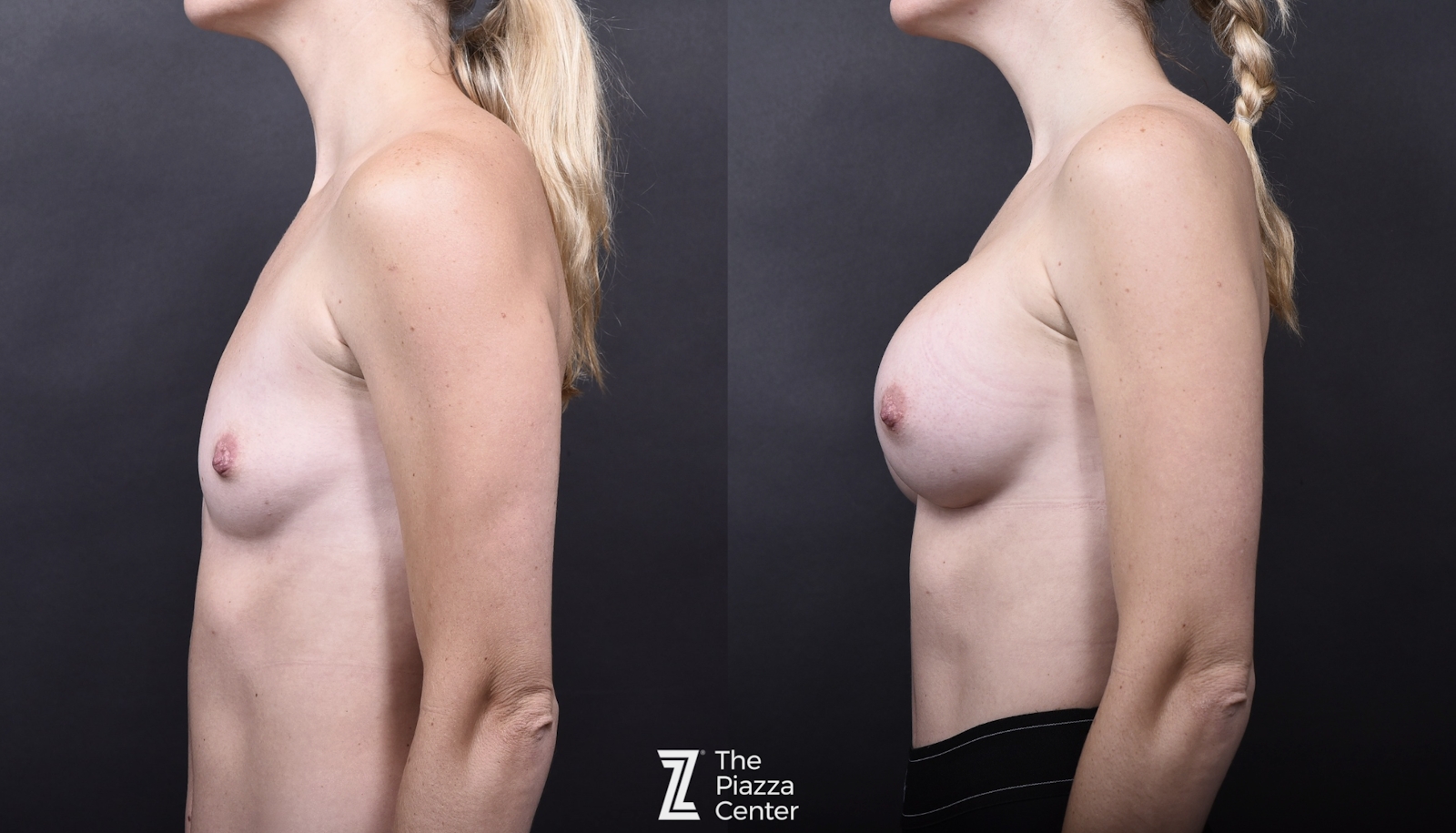 Austin Breast Augmentation Side Comparison - The Piazza Center