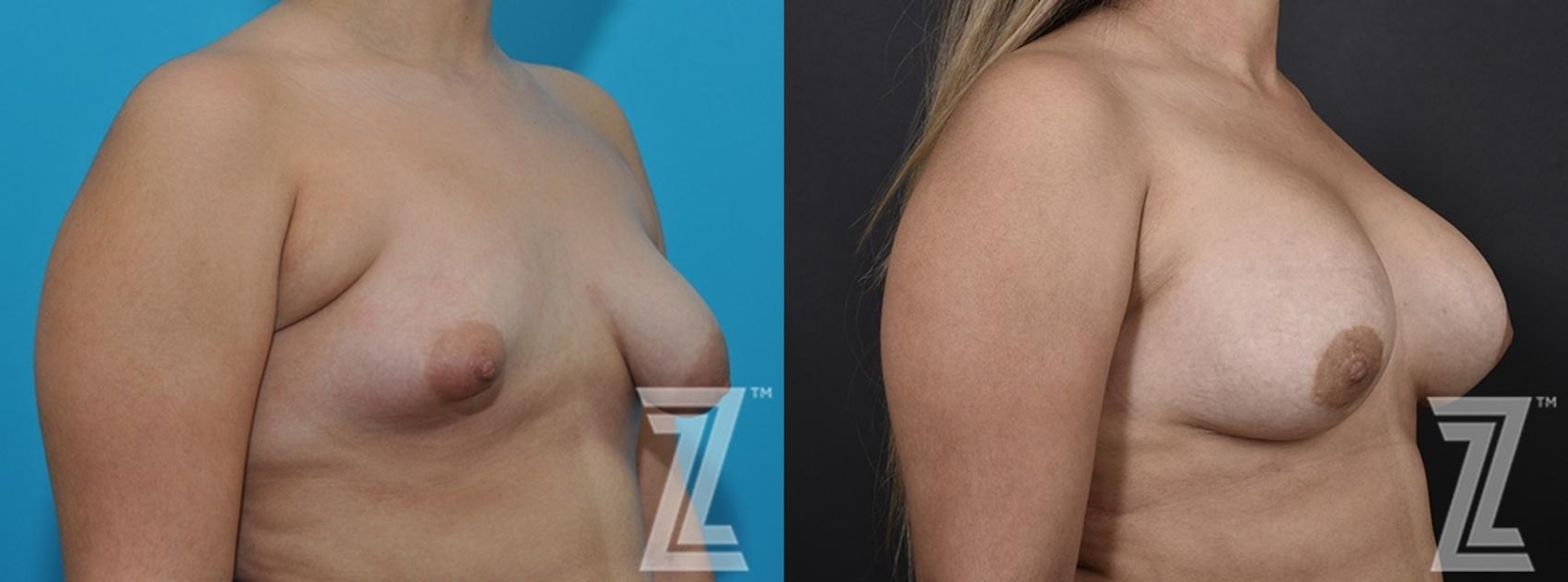 Austin Correction of Breast Asymmetry Before & After Gallery - Patient 132886781 - Image 4 - The Piazza Center