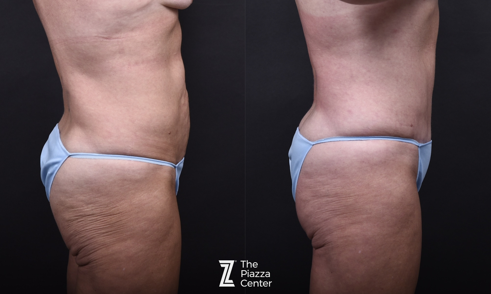 Austin Breast Augmentation Before & After Gallery - Patient 158035 - Image 6 - The Piazza Center