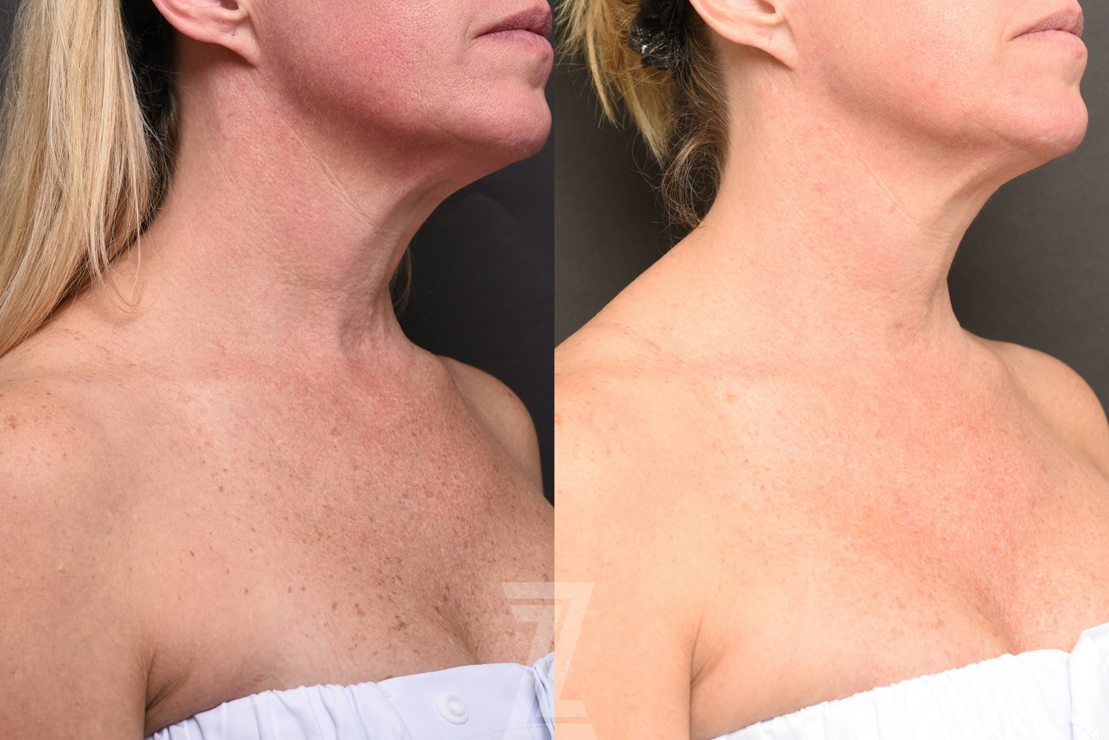 Austin BBL Before & After Gallery - Patient 138650 - Image 3 - The Piazza Center