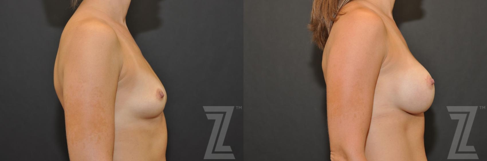 Austin Lateral view before & after images of 32-year-old mother of two 6 month post op breast augmentation - The Piazza Center - The Piazza Center