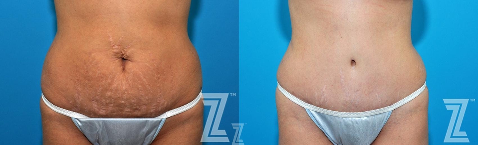 Austin 36 year old woman 1 year post op front abdominal view mommy makeover - Austin Tx, The Piazza Center - The Piazza Center