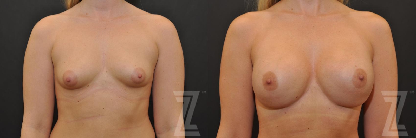 Austin Bilateral view before & after images of 24 year old woman with Silicone Implants with Cohesive Silicone Gel - Dr. Rocco Piazza - The Piazza Center