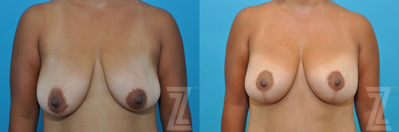 Austin Breast Augmentation With a Breast Lift Before & After Gallery - Patient 132791096 - Image 1 - The Piazza Center