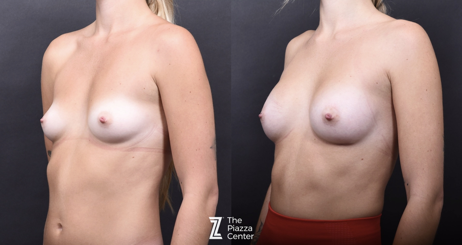 Austin Motiva Preservé/Breast Tissue Preservation Before & After Gallery - Patient 964775 - Image 4 - The Piazza Center