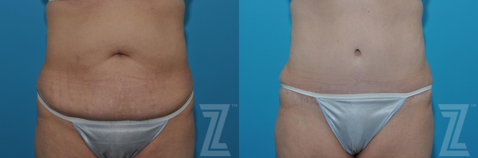 Austin Tummy Tuck Before & After Gallery - Patient 132886869 - Image 1 - The Piazza Center
