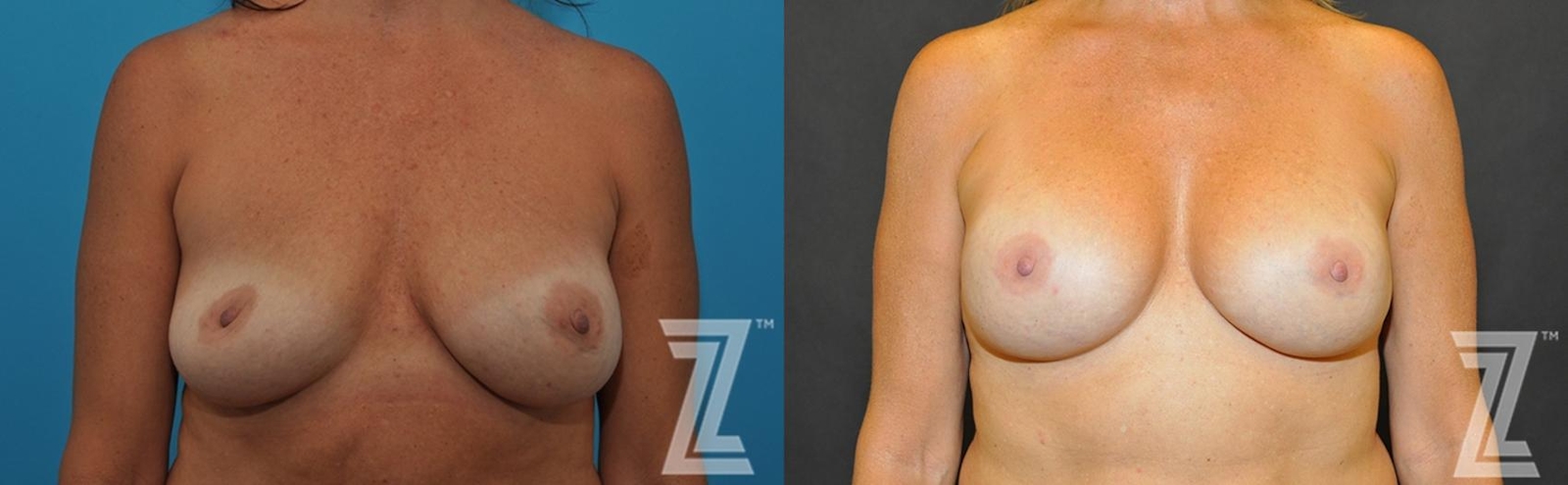 Austin Breast Augmentation Revision Before & After Gallery - Patient 132886563 - Image 1 - The Piazza Center
