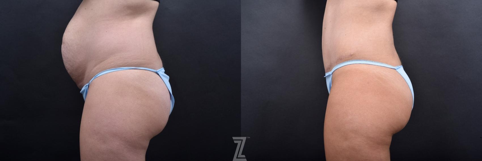 Austin Tummy Tuck Before & After Gallery - Patient 132886800 - Image 2 - The Piazza Center