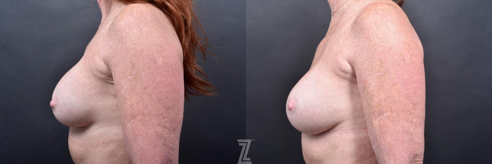 Austin Breast Augmentation Revision Before & After Gallery - Patient 132886568 - Image 3 - The Piazza Center