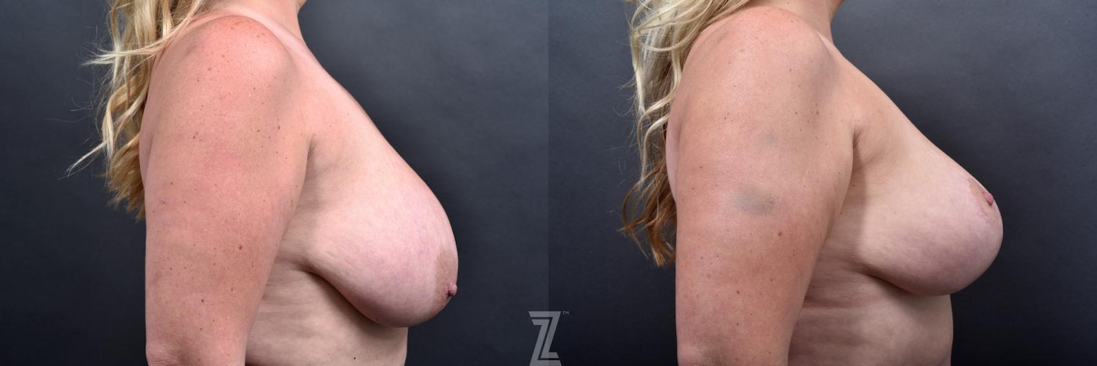 Austin Breast Reduction Before & After Gallery - Patient 132886609 - Image 5 - The Piazza Center