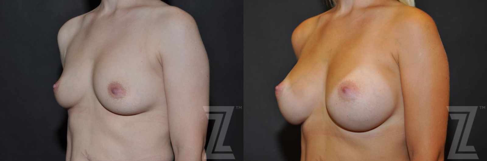 Austin Oblique View 6 Months After Breast Augmentation in Austin, TX Before & After by Dr. Rocco Piazza - The Piazza Center