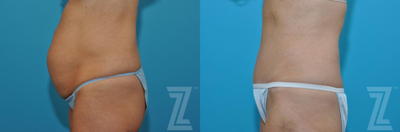 Austin Tummy Tuck Before & After Gallery - Patient 132886871 - Image 2 - The Piazza Center