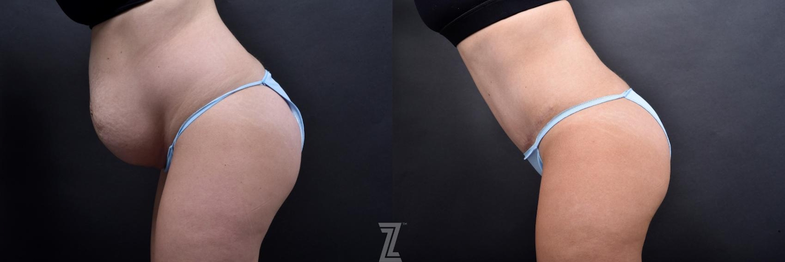 Austin Tummy Tuck Before & After Gallery - Patient 132886800 - Image 3 - The Piazza Center