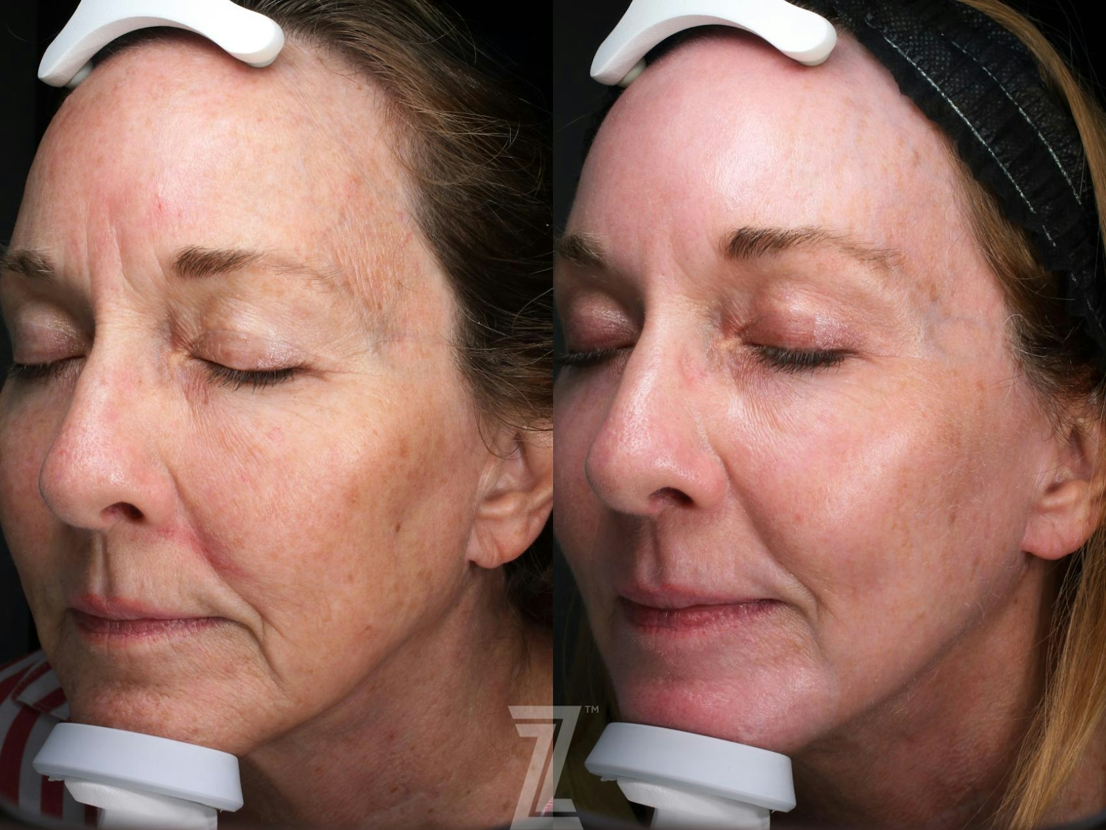 Austin Visia Skincare Analysis Before & After Gallery - Patient 132963279 - Image 1 - The Piazza Center
