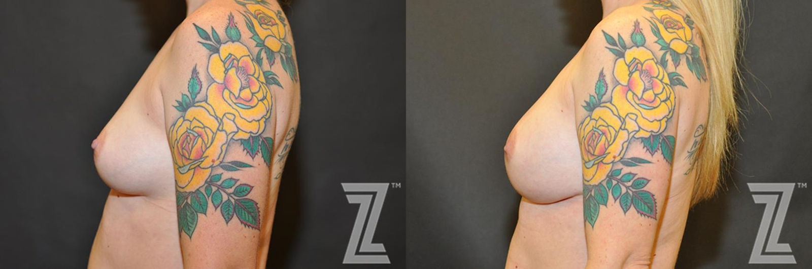Austin Breast Reconstruction Before & After Gallery - Patient 132886770 - Image 3 - The Piazza Center