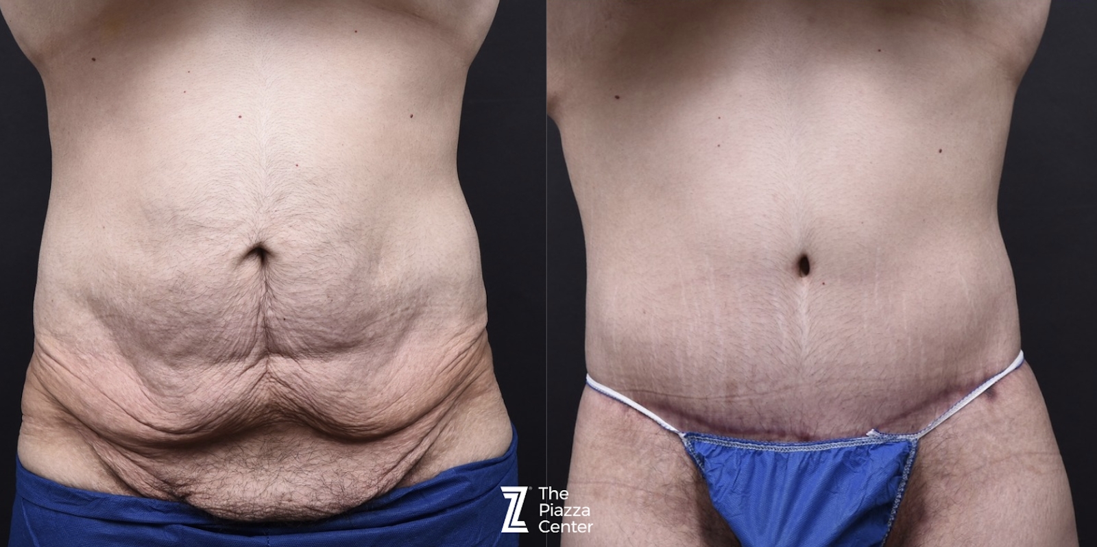 Austin Male Body Contouring Before & After Gallery - Patient 374227 - Image 1 - The Piazza Center