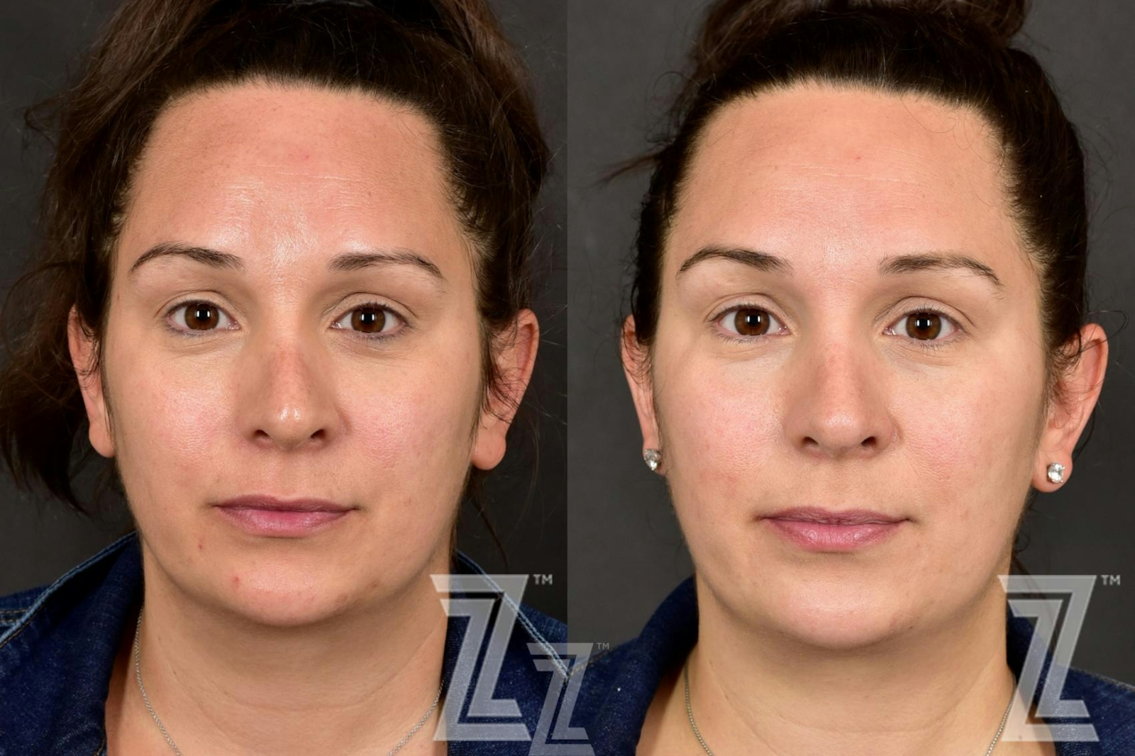 Austin HALO Before & After Gallery - Patient 132963258 - Image 1 - The Piazza Center